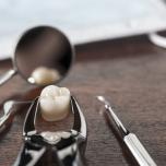Estrazione dente devitalizzato rotto