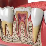 In quanto tempo muore il nervo del dente