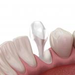 Perno dente devitalizzato