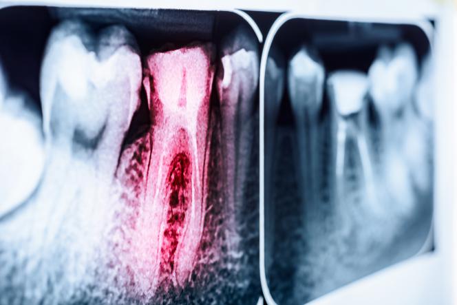 Cos'è l'endodonzia Cos'è l'endodonzia