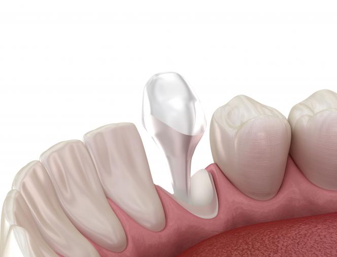 Perno dente devitalizzato info sul perno devitalizzato