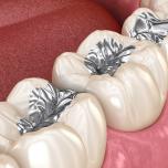 Amalgama dentale dopo 20 anni