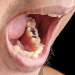 Amalgama dentale