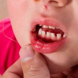 Avulsione dentale