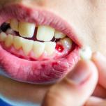 Coagulo dopo estrazione dente