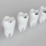 Come chiudere un buco nel dente
