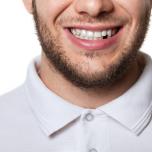 Come nascondere un dente mancante