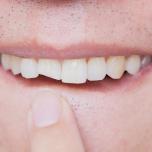 Come nascondere un dente rotto