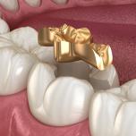 Copri denti