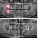 Cosa fare dopo estrazione dente del giudizio