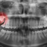 Cosa mangiare dopo estrazione dente del giudizio