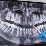 Crescita dente del giudizio