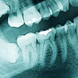 Dente 28