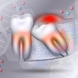 Dente cresciuto sulla gengiva