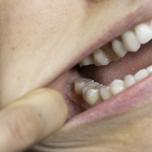 Dente del giudizio incluso