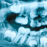 Dente del giudizio storto verso la guancia 