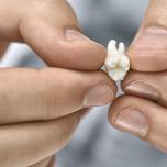 Dente estratto