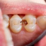 Dente marcio sintomi