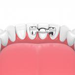 Dente provvisorio con alette costo