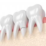 Dente rotto alla radice