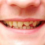 Dente rotto