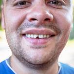 Dente scheggiato costo
