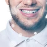 Dente scheggiato