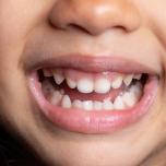 Dente scuro