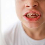 Denti all'infuori