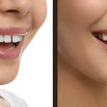 Denti canini superiori