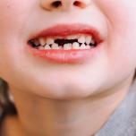 Denti da latte radici