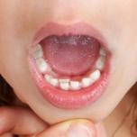 Denti doppi 