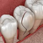 Denti fragili che si rompono 