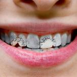Denti fragili