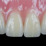 Denti incisivi