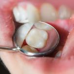 Denti limati