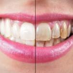 Denti senza smalto