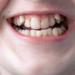 Denti storti