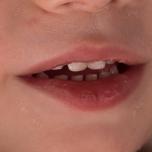 Dermatite da dentizione
