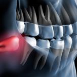Estrazione dente del giudizio quanto dura
