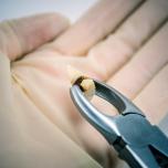 Estrazione dente del giudizio superiore fa male