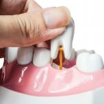 Estrazione dente radice rotta