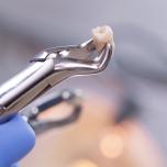Estrazione dente