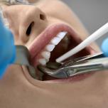 Estrazione denti per sovraffollamento