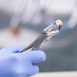 Estrazione radice dente fa male