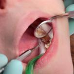 Foro cieco denti