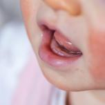 Gengive neonato 4 mesi
