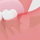 I denti del giudizio crescono a tutti