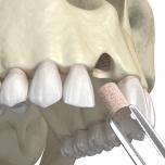 Innesto osseo dentale