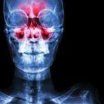 Ispessimento mucoso del seno mascellare destro